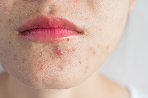 Effective Ways to Get Rid of Hyperpigmentation